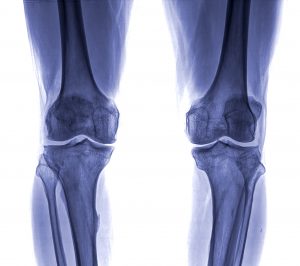 Knee X-ray Singapore Clinic