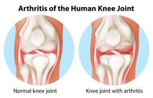 Knee Joint Consist